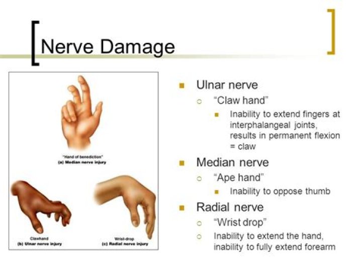 What causes ulnar claw